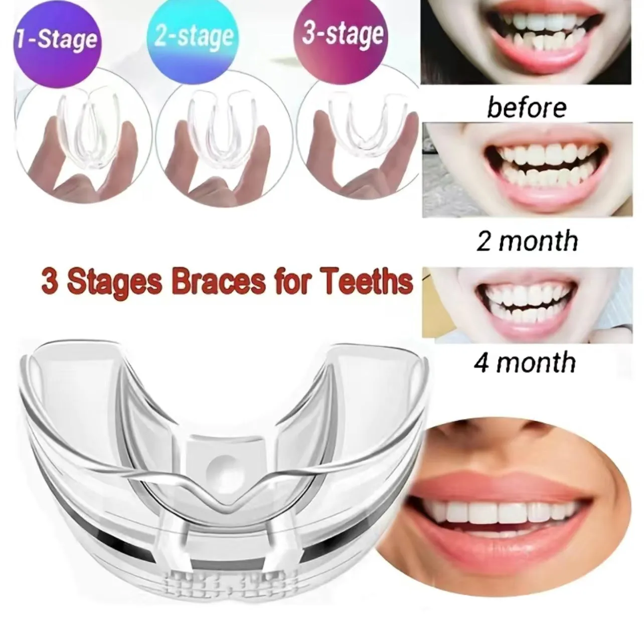 3 Stage Overnight Teeth Aligners - 3 Phase Night Guard Braces