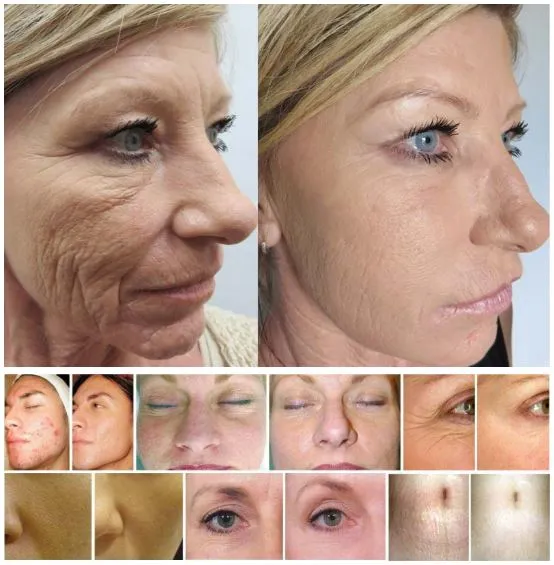 Dr. Pen M8  Rechargeable Micro-Needling Anti-Aging Therapy Pen System
